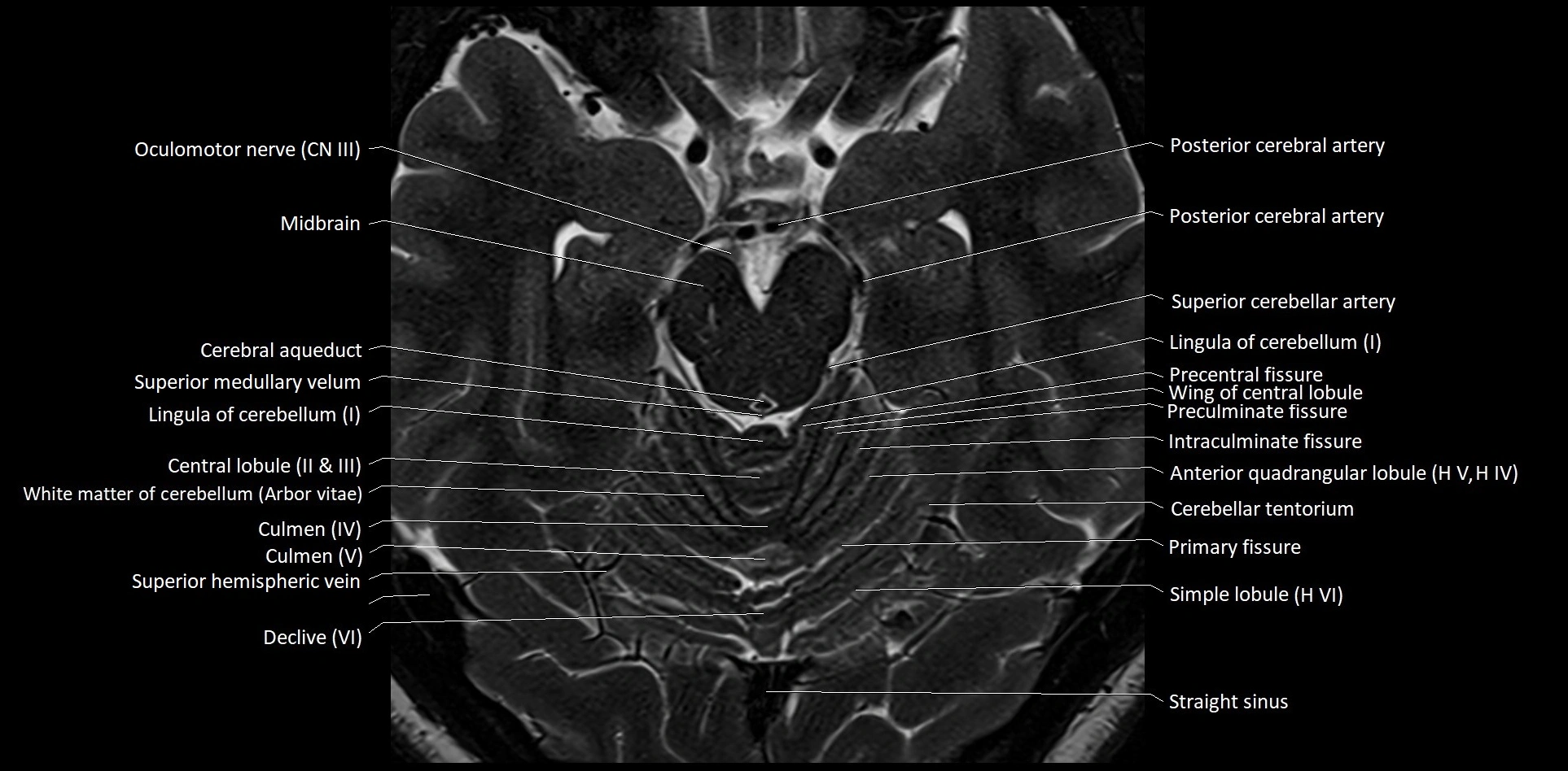 MRI Cerebellar anatomy High-resolution labelled 3T MRI image 22.webp